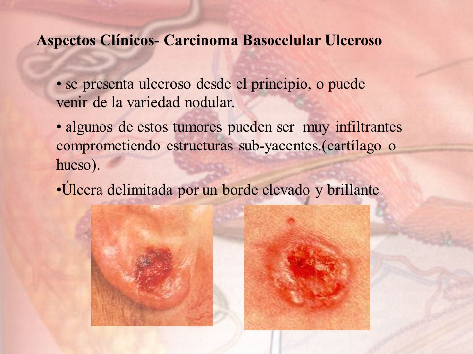 carcinoma basocelular de tipo nodular pigmentado